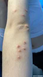 日均接診20例，9歲女童中招！專家：警惕蚊蟲叮咬引發丘疹性蕁麻疹