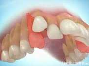 牙齒矯正拔牙有什麼危害呢？正畸拔牙的原則是什麼？