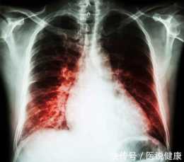 肺結節會不會發生惡變？這3類人或是“高危人群”，別忽視