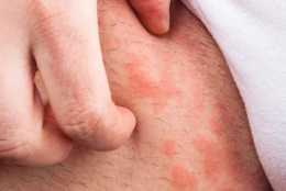 夏季易患蕁麻疹的原因有哪些？竟跟空調有關？如何防護呢？