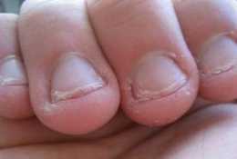 小孩喜歡咬指甲是缺鋅嗎,有什麼方法可以改正啃指甲?