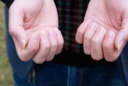 雙手頻繁發麻，可能是身體發出的求救訊號，需小心五種常見病