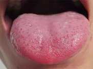 舌頭下的“青筋”是什麼青筋顏色不同代表疾病不同，你清楚嗎