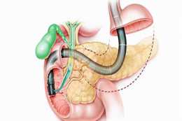 肝外膽管損傷，在臨床上較常見，好發於膽囊切除術後患者