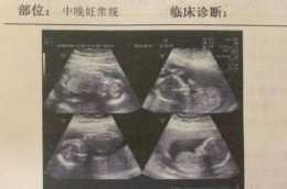 四胞胎同年不同日生 山東產婦實施罕見延遲分娩