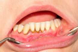 牙齦炎的生前身後事，盤點牙齦炎的6個原因，牙結石不可小覷