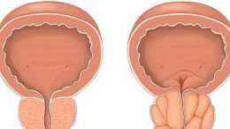 前列腺增生導致夜尿多，如何抓住“黃金”治療期？