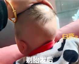 寶寶滿月剃胎毛後區域性難長髮，媽媽：診斷毛囊閉合，實在不行只能植髮了