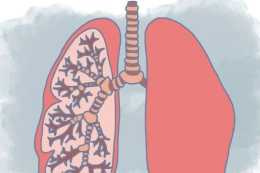 經常咳嗽痰多，體檢有肺結節是不是肺癌？聽聽醫生怎麼說？