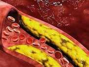 身體出現5訊號，是血管在求救，可惜很多人忽視了，致性血管疾病