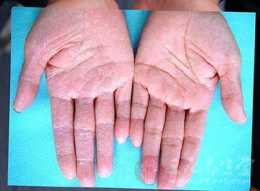 手脫皮是什麼原因 這樣做可以治療手脫皮